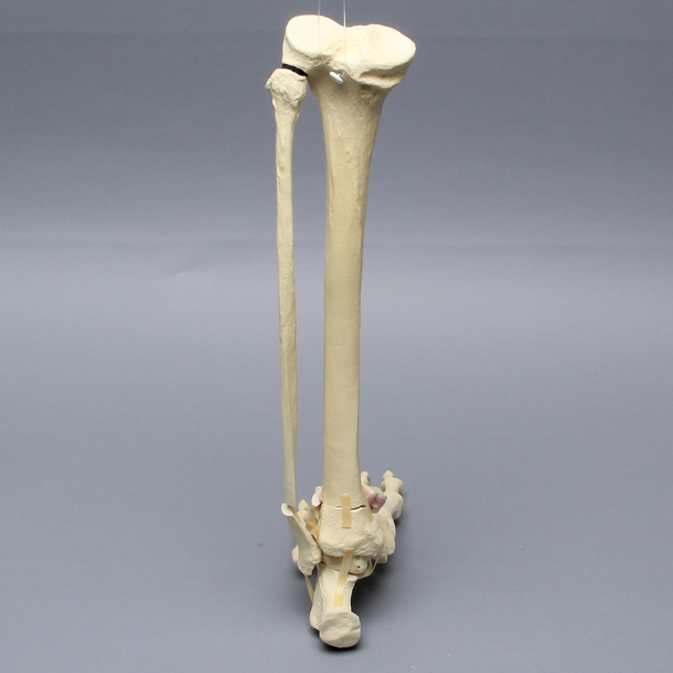Foot and Ankle with Articulation and Tibial Pilon and Transverse Fibular Fractures