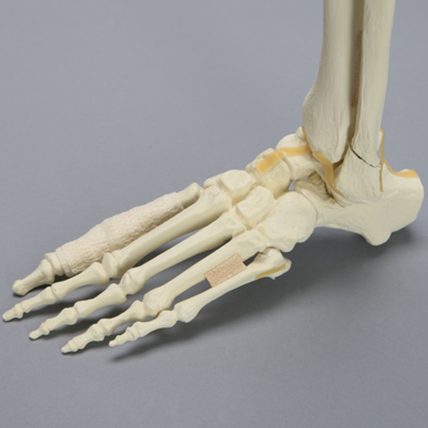 Foot and Ankle with Fractures and Articulation at IP Joint