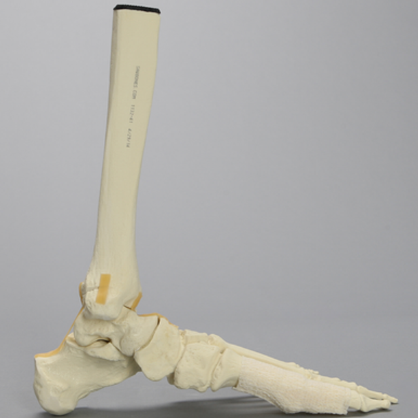 Foot and Ankle with Fractures and Articulation at IP Joint