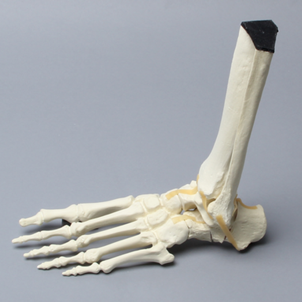 Foot and Ankle with Calcaneal Fracture