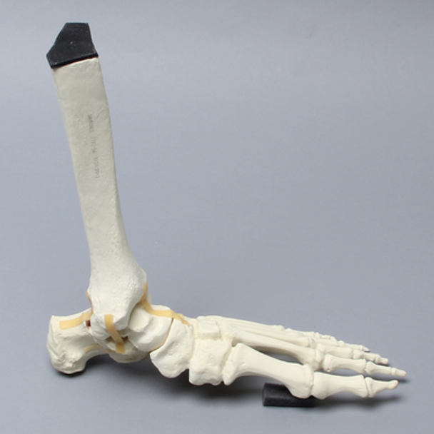 Foot and Ankle with Calcaneal Fracture