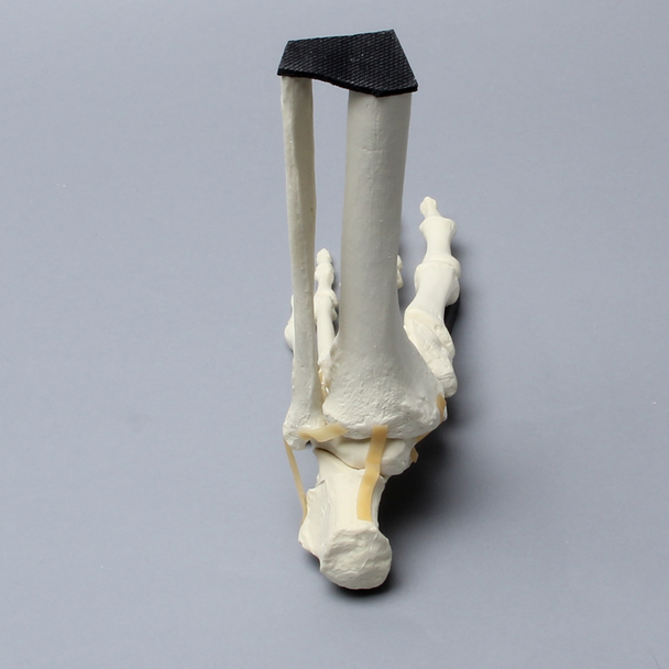 Foot and Ankle with Calcaneal Fracture