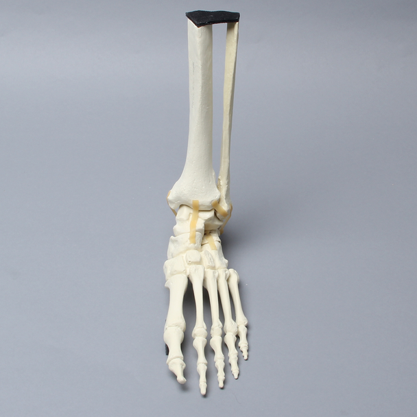 Foot and Ankle with Calcaneal Fracture