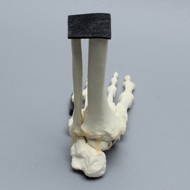 Foot and Ankle with Arthritis and Calcaneal Malunion
