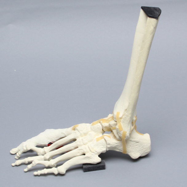 Foot and Ankle with Five-Part Talar Fracture, Bunions, and Hammertoes