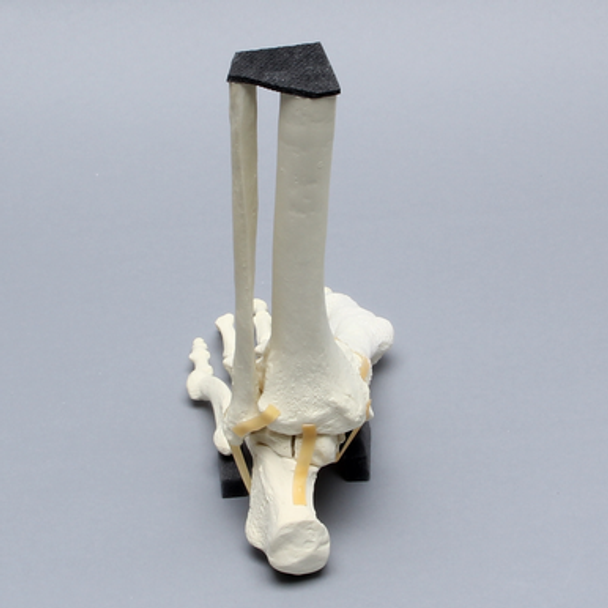 Foot and Ankle with Five-Part Talar Fracture, Bunions, and Hammertoes