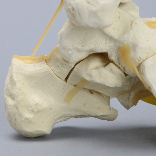 Foot and Ankle with Four-Part Calcaneal Fracture