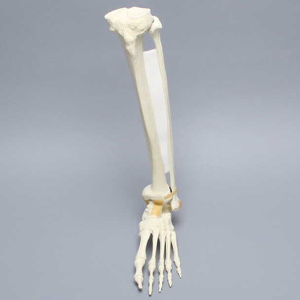 Foot and Ankle with Multiple Deformities, 18 Degree Varus and 10 Degree Recurvatum