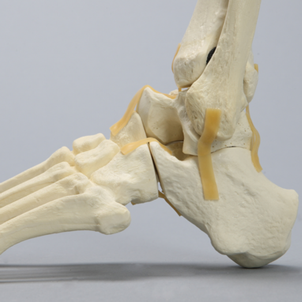 Foot and Ankle with Cavus Deformity