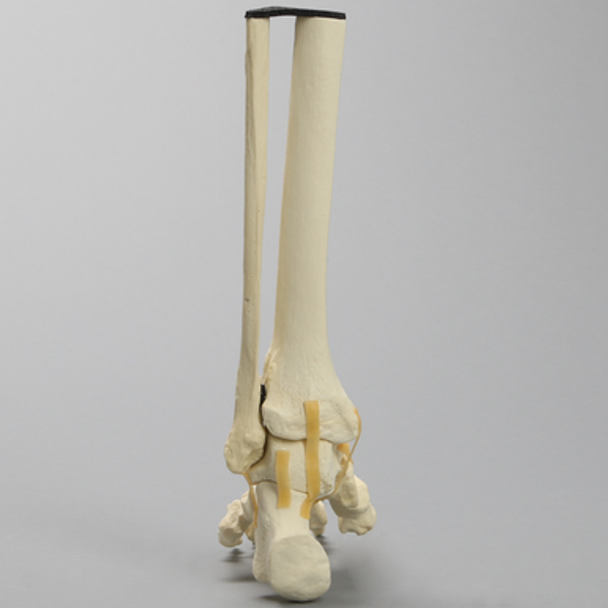 Foot and Ankle with Cavus Deformity