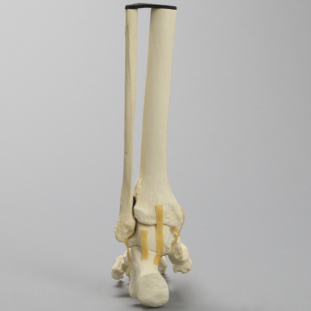 Foot and Ankle with Cavus Deformity