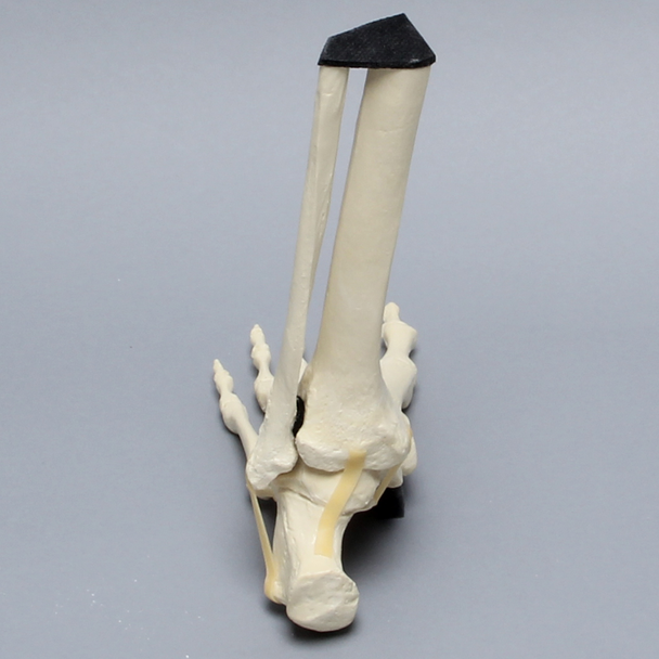 Foot and Ankle with Lisfranc Fracture