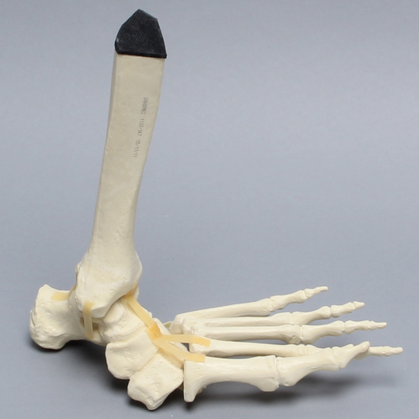 Foot and Ankle with Lisfranc Fracture