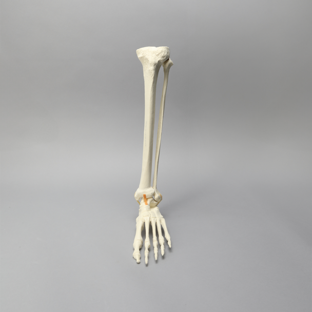 Foot and Ankle with Malunion and Valgus Deformity