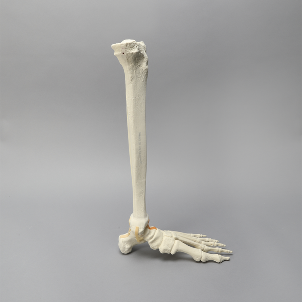 Foot and Ankle with Malunion and Valgus Deformity