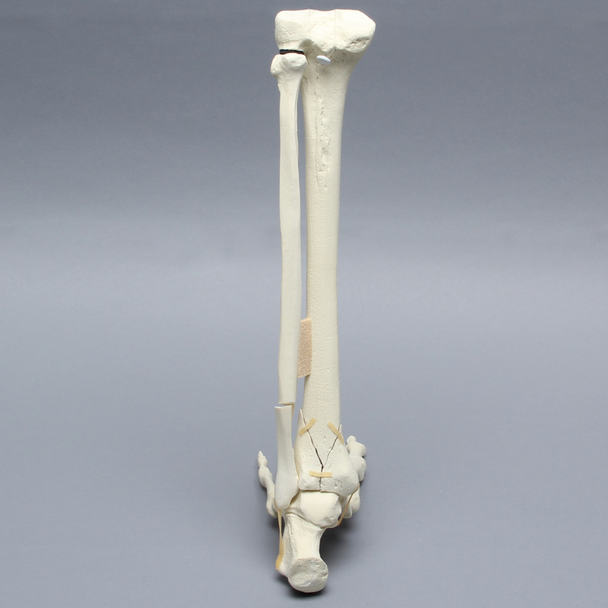 Foot and Ankle with Tibial Four-Part Pilon and Fibular Oblique Fractures