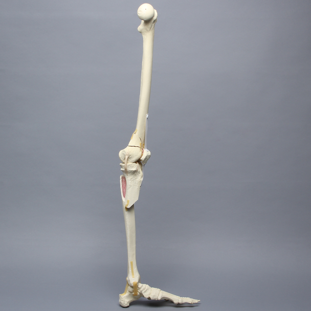Full Leg with Femoral "Y" and Tibial Oblique Fractures