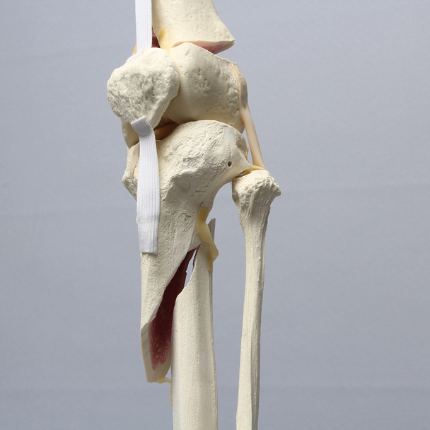 Full Leg with Femoral "Y" and Tibial Oblique Fractures