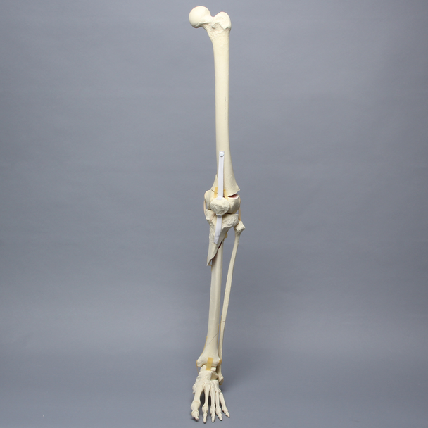 Full Leg with Femoral "Y" and Tibial Oblique Fractures