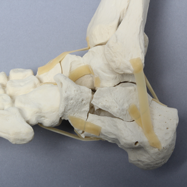 Foot and Ankle with Wall and Neck Fractures of Calcaneus and Talus