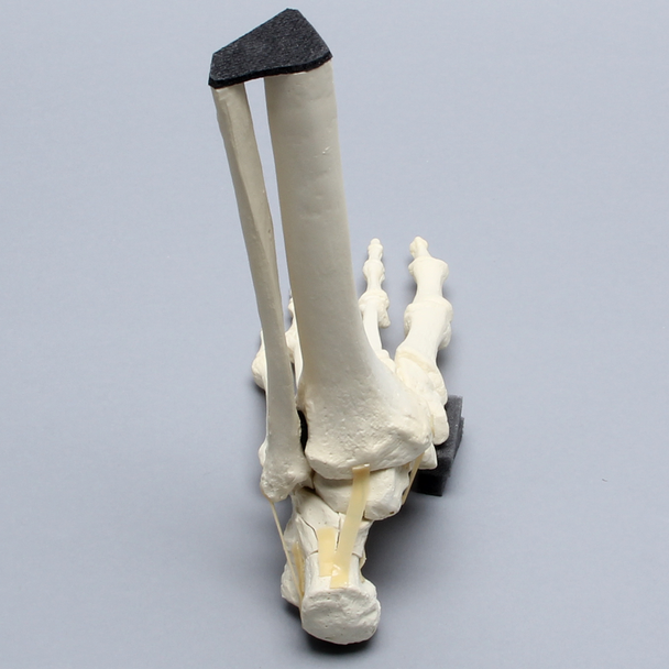 Foot and Ankle with Wall and Neck Fractures of Calcaneus and Talus