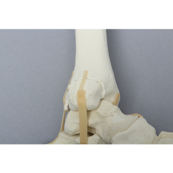 Foot and Ankle with Malleolar Fractures