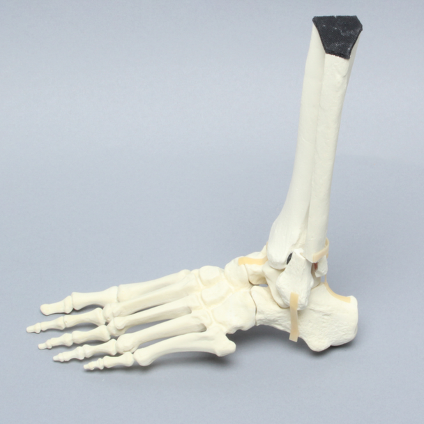 Foot and Ankle with Malleolar Fractures