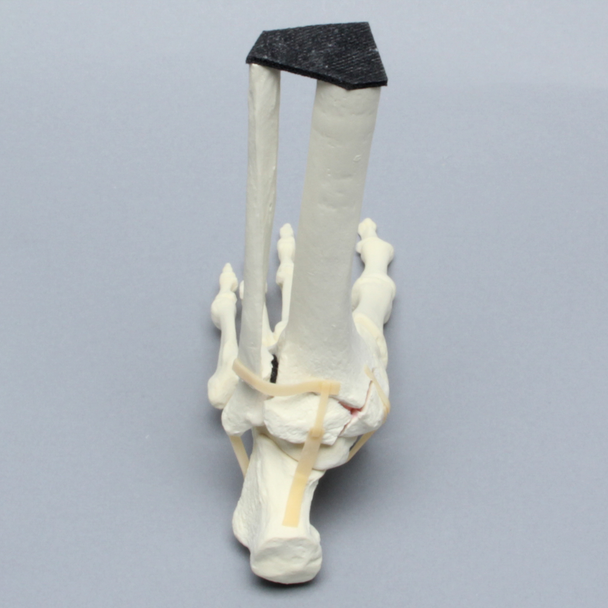 Foot and Ankle with Malleolar Fractures