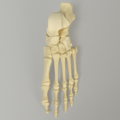 Foot with Flatfoot Condition