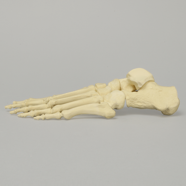 Foot with Flatfoot Condition