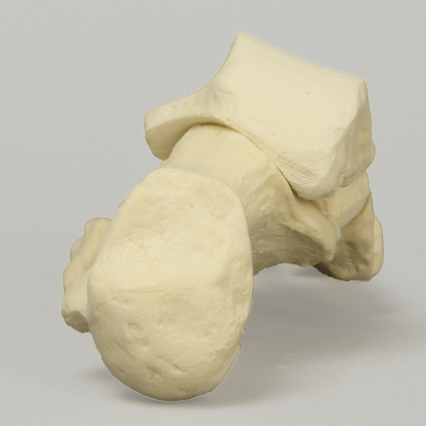 Foot with Flatfoot Condition