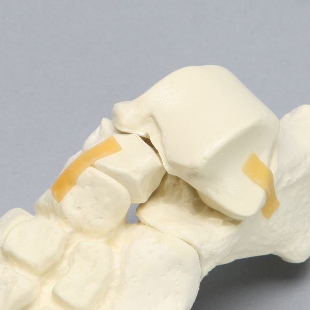 Foot includes a two-part fracture of the talus reattached with latex bands.