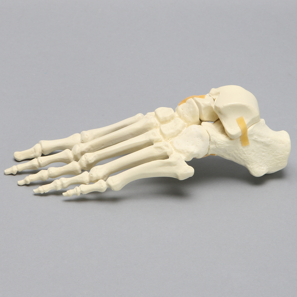 Foot includes a two-part fracture of the talus reattached with latex bands.