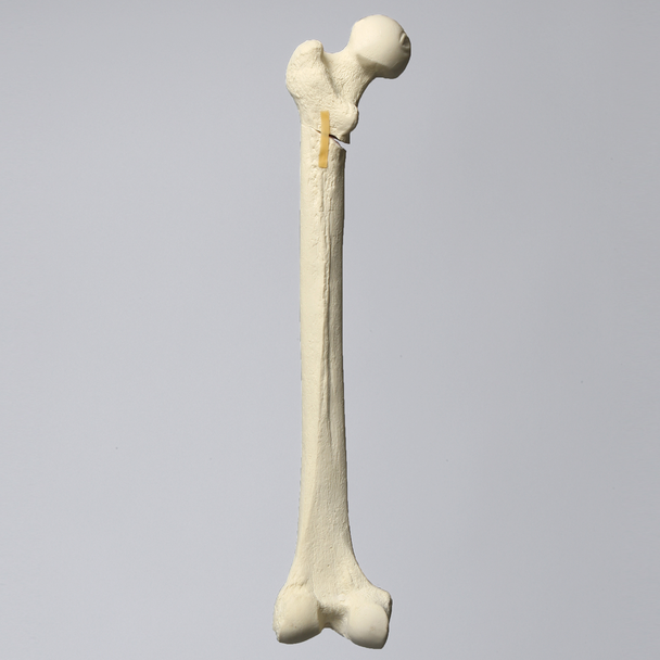 Femur with Subtrochanteric Oblique Fracture