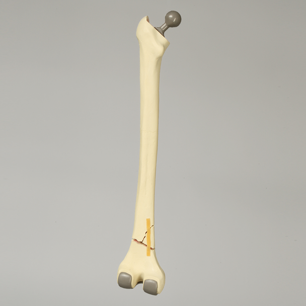 Femur with Distal Fracture and Implants