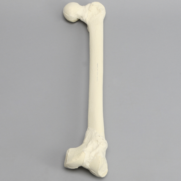 Femur with Nonunion and Displaced Malunion