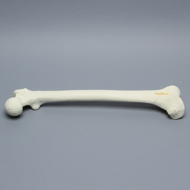 Femur with Supracondylar Fracture