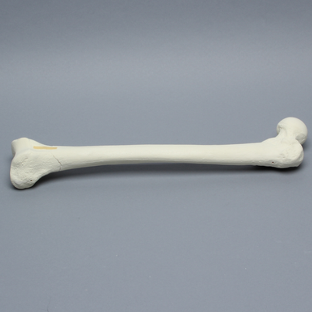 Femur with Supracondylar Fracture