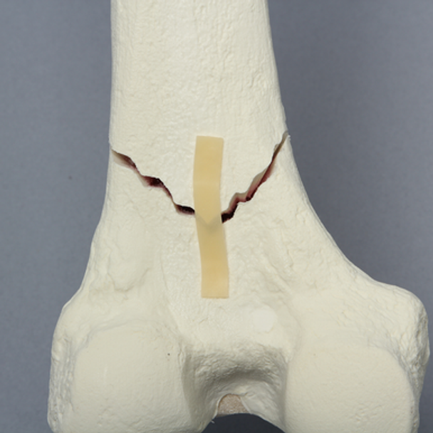 Femur with Supracondylar Fracture