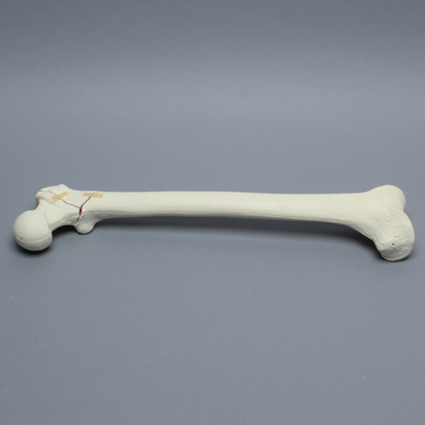 Femur with Intertrochanteric Three-Part Fracture