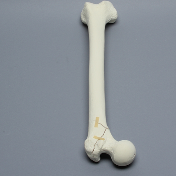 Femur with Intertrochanteric Three-Part Fracture