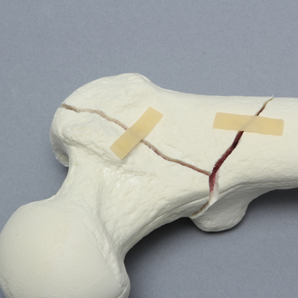 Femur with Intertrochanteric Three-Part Fracture