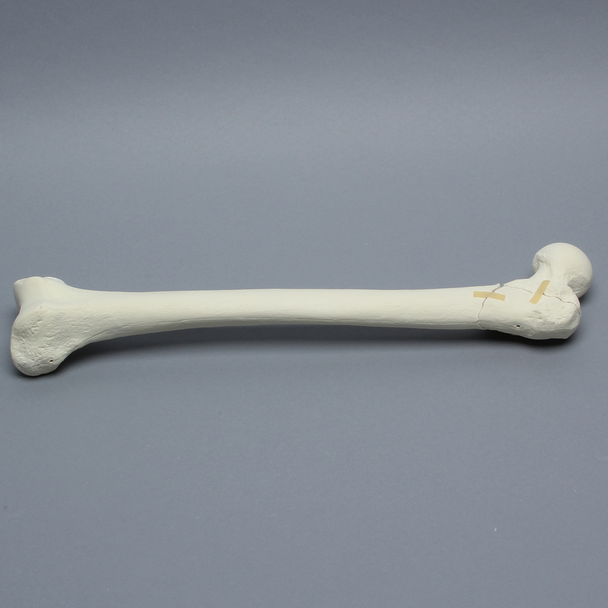 Femur with Intertrochanteric Three-Part Fracture
