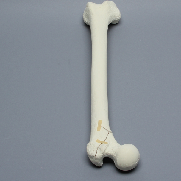 Femur with Intertrochanteric Three-Part Fracture