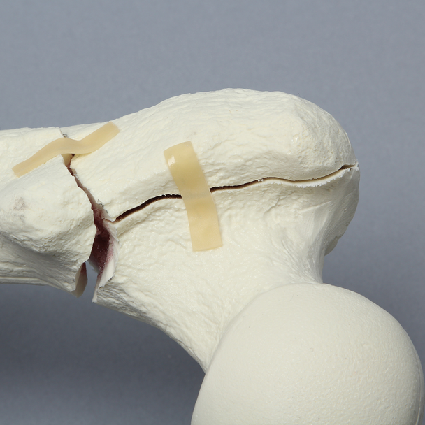 Femur with Intertrochanteric Three-Part Fracture