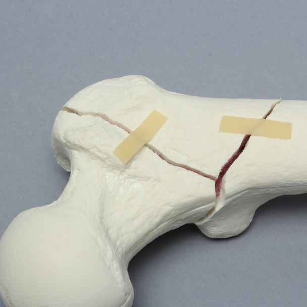 Femur with Intertrochanteric Three-Part Fracture