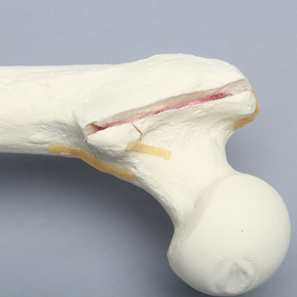 Femur with Intertrochanteric Fracture and Small Fragment