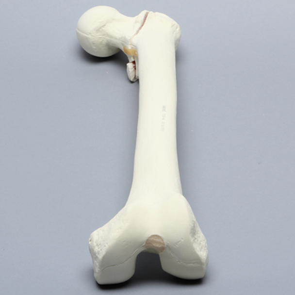 Femur with Intertrochanteric Fracture and Small Fragment