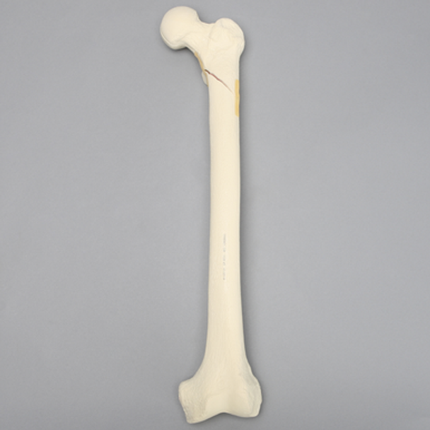 Femur with Subtrochanteric Spiral Fracture