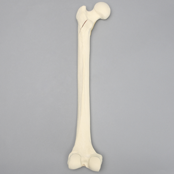 Femur with Subtrochanteric Spiral Fracture